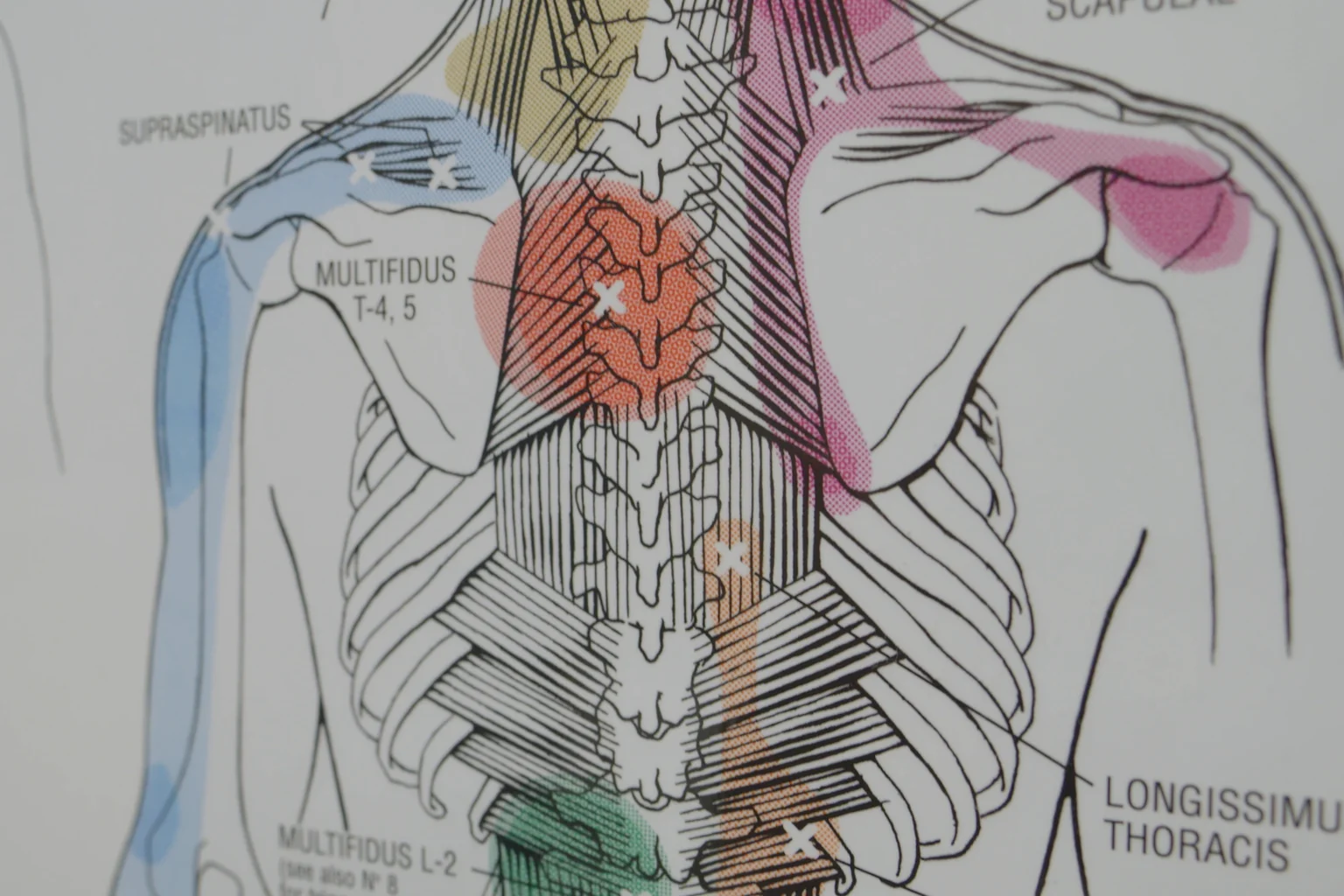 A trigger point chart of the upper back and shoulder muscles on a treatment room wall at Advanced Pain Solutions